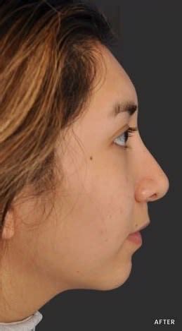Nose Shaping Solutions Overview: Cost, Recovery, .